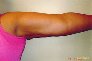 arm liposuction after