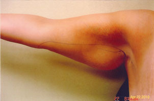 arm liposuction after