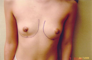 breast augmentation before
