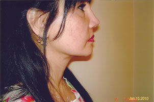 chin liposuction after