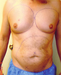 chin liposuction before