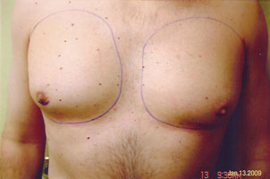 chin liposuction before