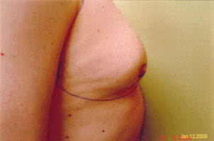 chin liposuction before