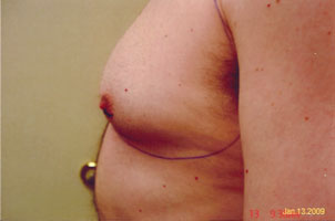 chin liposuction before
