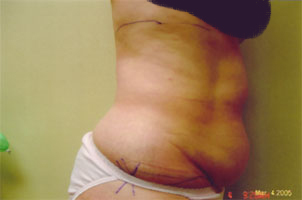 chin liposuction before