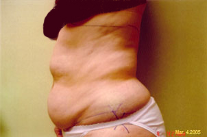 chin liposuction before