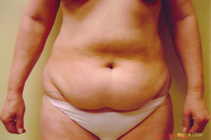 chin liposuction before