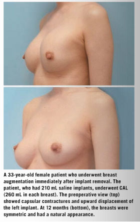Stem cell enriched fat tissue offers organic look and feel