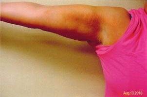 arm liposuction