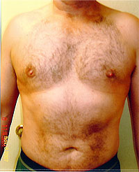 chin liposuction after