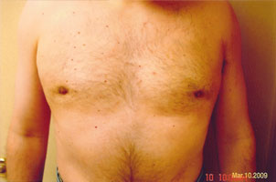 chin liposuction after