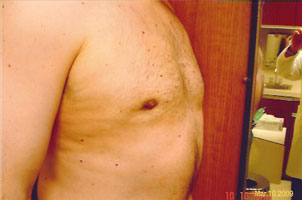 chin liposuction after