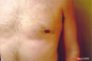 chin liposuction after