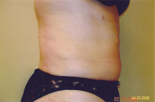 chin liposuction after