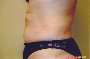 chin liposuction after