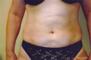 chin liposuction after